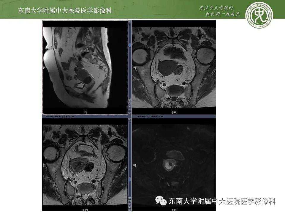 【PPT】子宫内膜异位症与子宫腺肌症的MR诊断