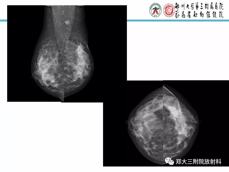 【PPT】乳腺X线病例分享