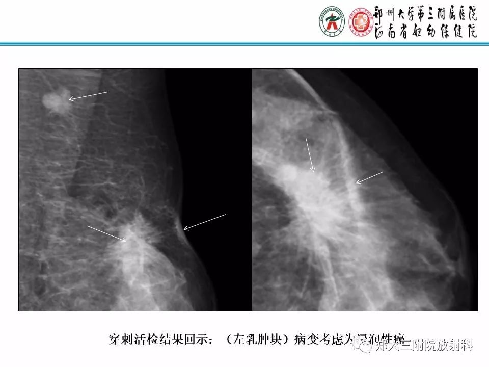 【PPT】乳腺X线病例分享