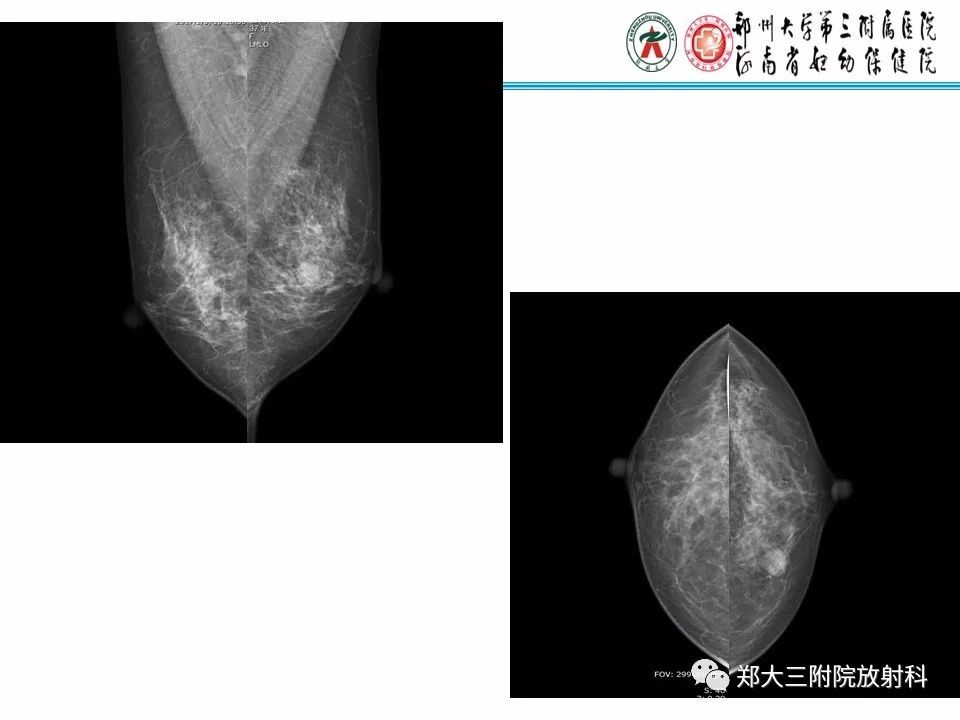【PPT】乳腺X线病例分享