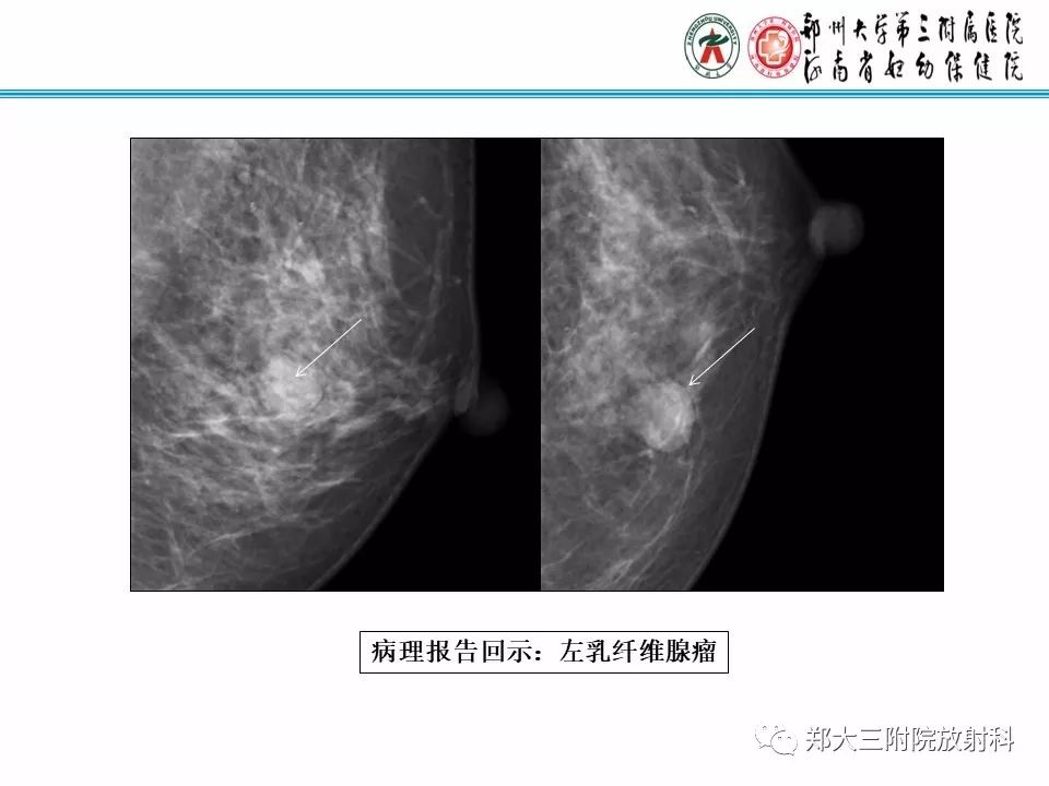 【PPT】乳腺X线病例分享