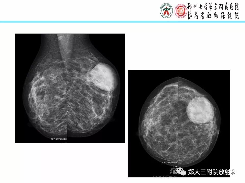 【PPT】乳腺X线病例分享