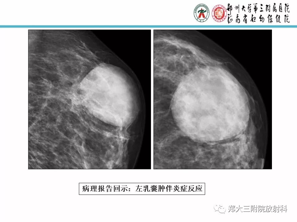 【PPT】乳腺X线病例分享