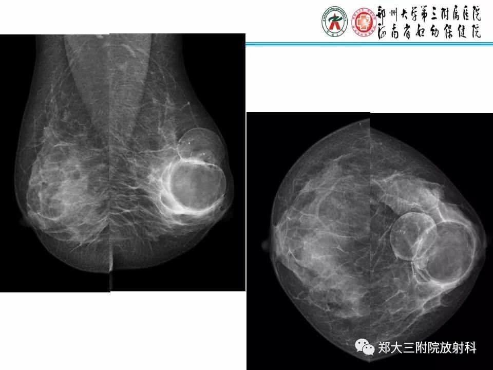 【PPT】乳腺X线病例分享