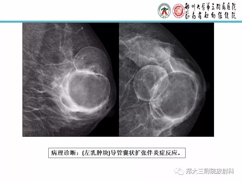 【PPT】乳腺X线病例分享