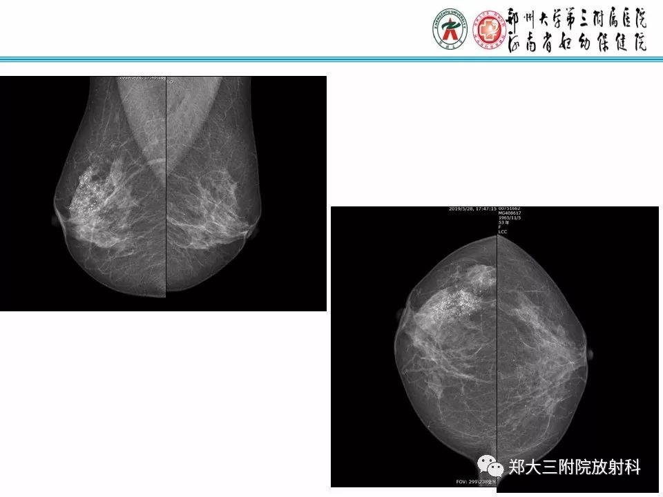 【PPT】乳腺X线病例分享