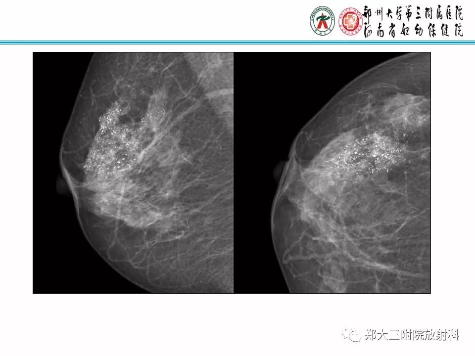 【PPT】乳腺X线病例分享