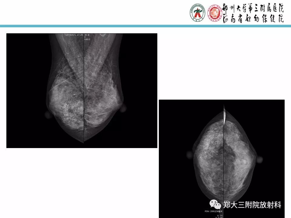 【PPT】乳腺X线病例分享