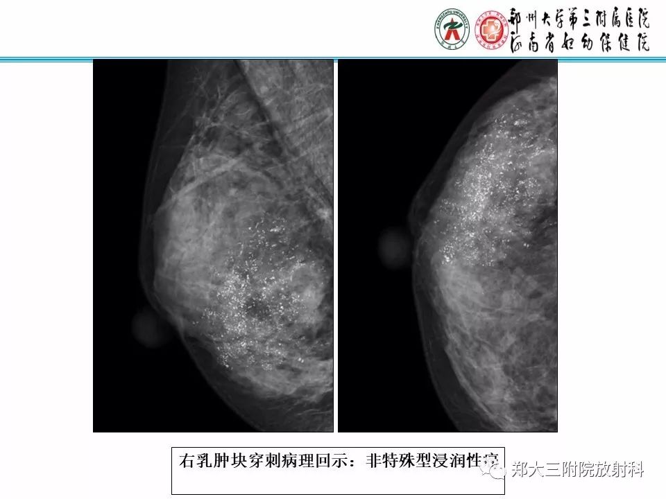 【PPT】乳腺X线病例分享