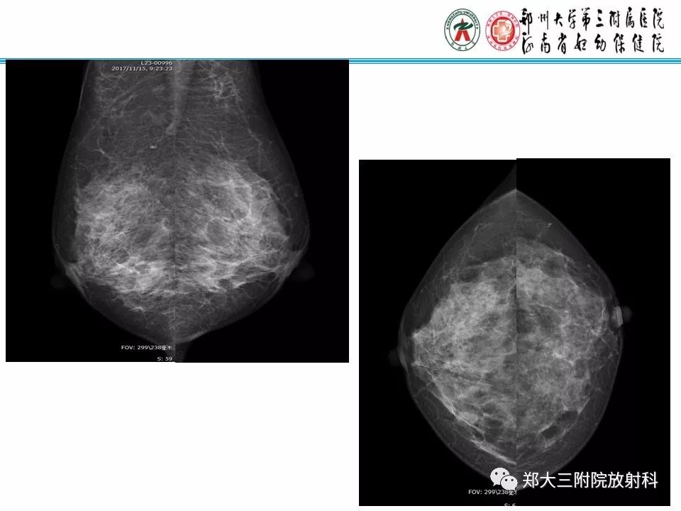 【PPT】乳腺X线病例分享