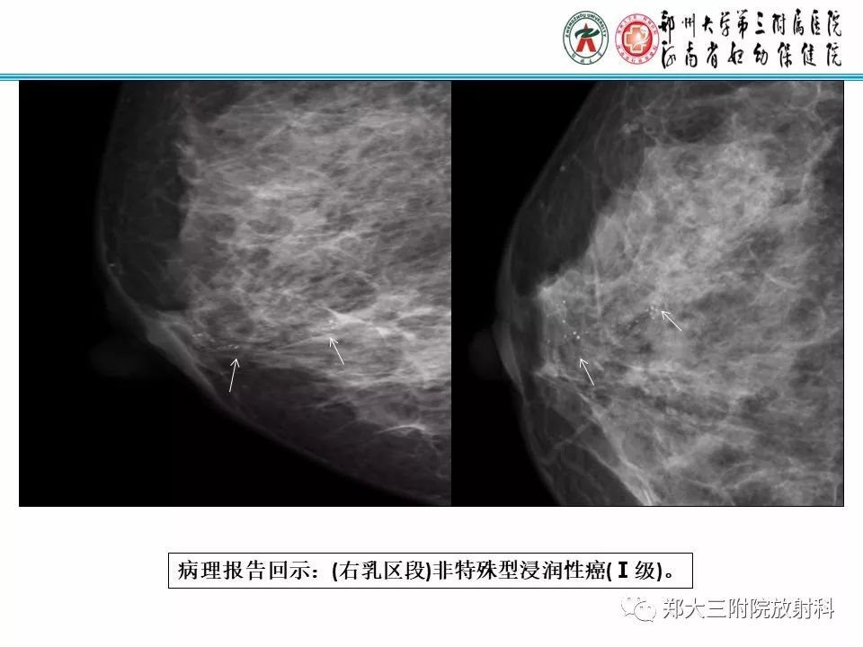 【PPT】乳腺X线病例分享