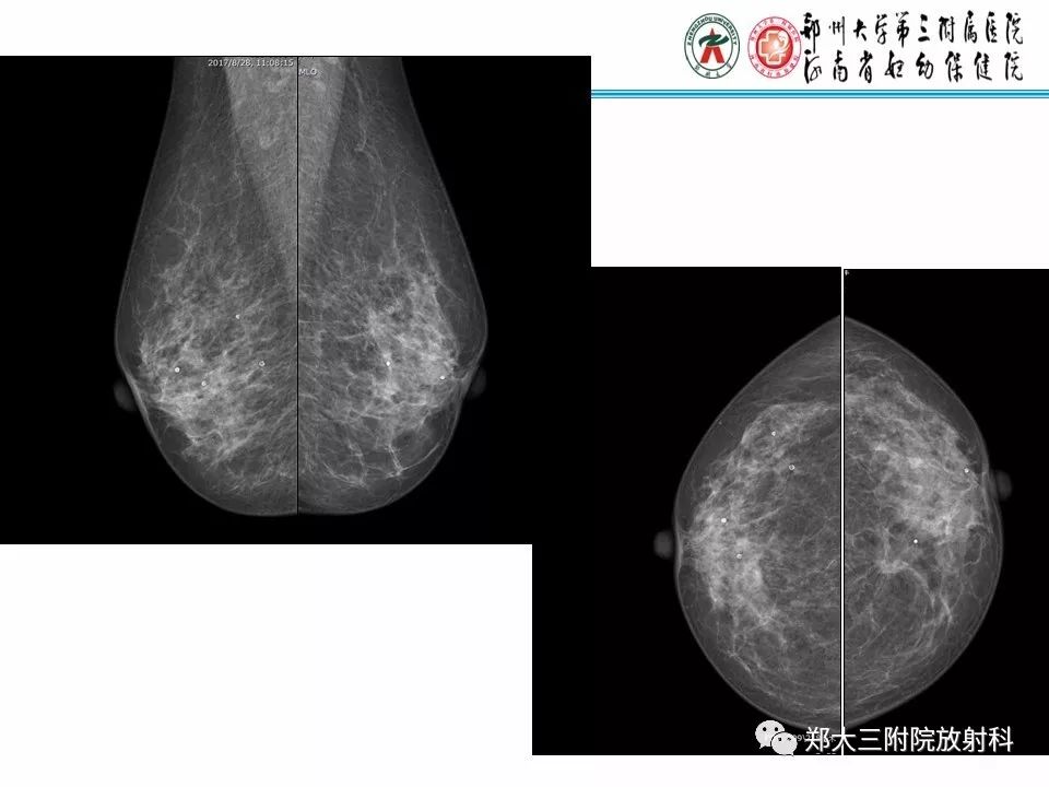 【PPT】乳腺X线病例分享