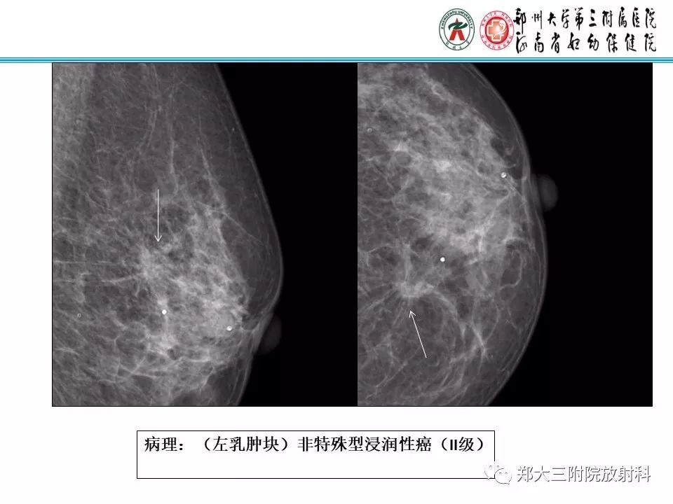 【PPT】乳腺X线病例分享