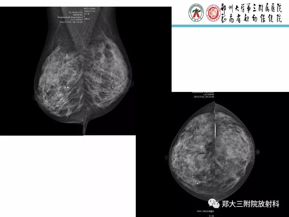 【PPT】乳腺X线病例分享