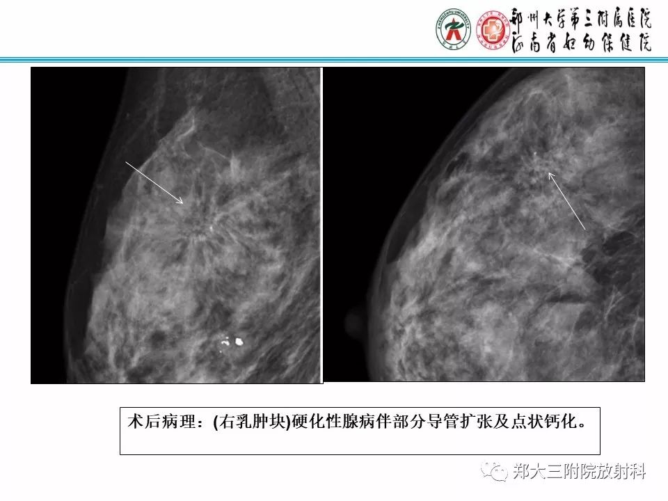 【PPT】乳腺X线病例分享