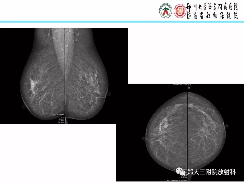 【PPT】乳腺X线病例分享