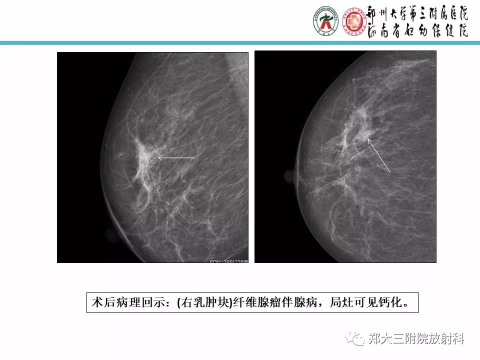 【PPT】乳腺X线病例分享