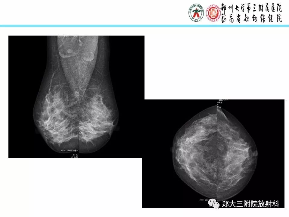 【PPT】乳腺X线病例分享