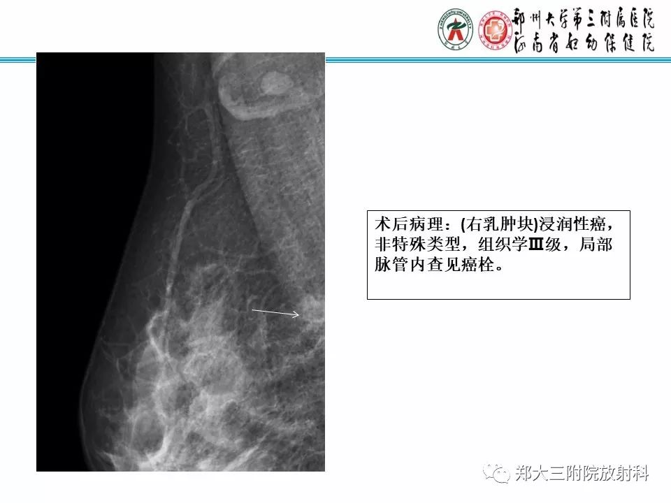【PPT】乳腺X线病例分享