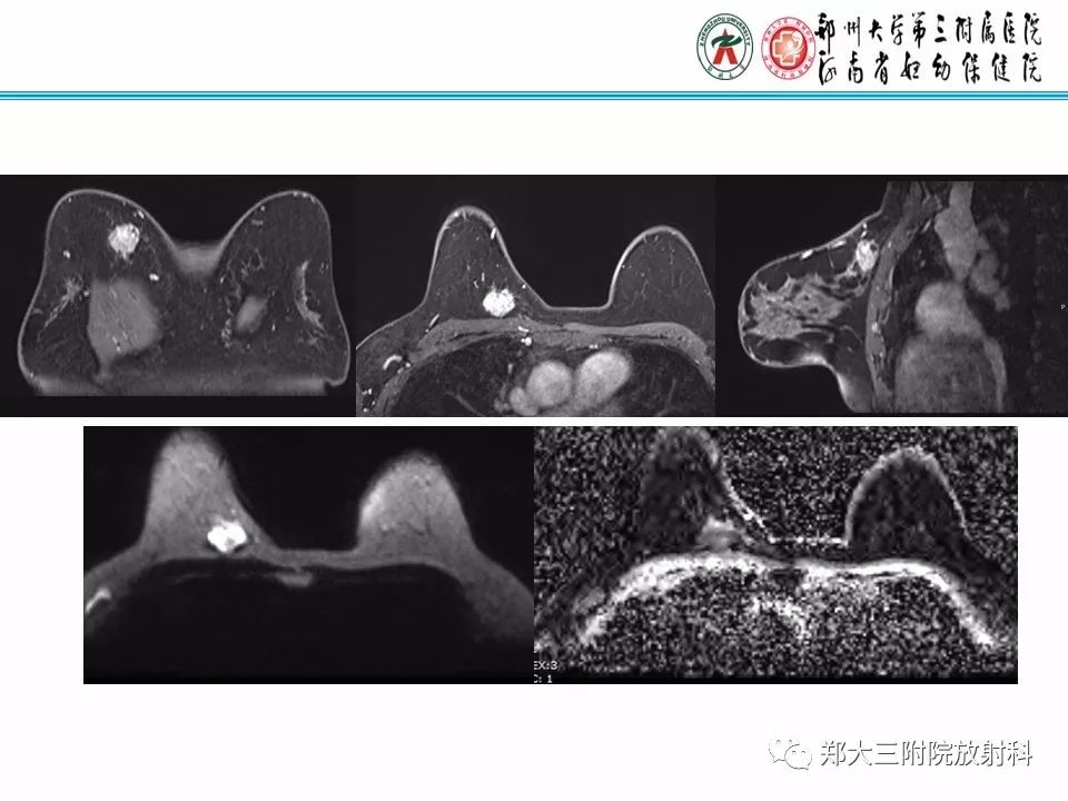 【PPT】乳腺X线病例分享