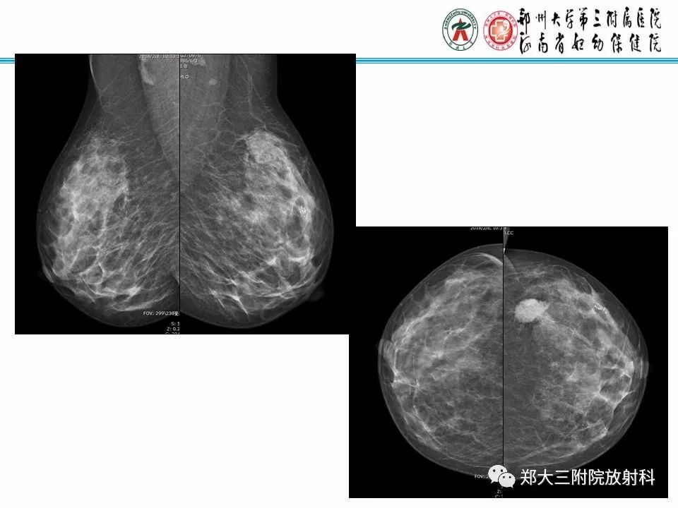 【PPT】乳腺X线病例分享
