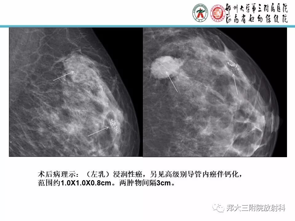 【PPT】乳腺X线病例分享