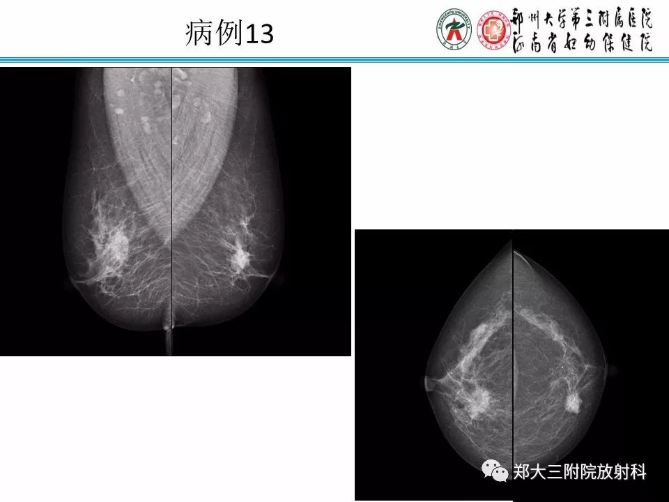 【PPT】乳腺X线病例分享