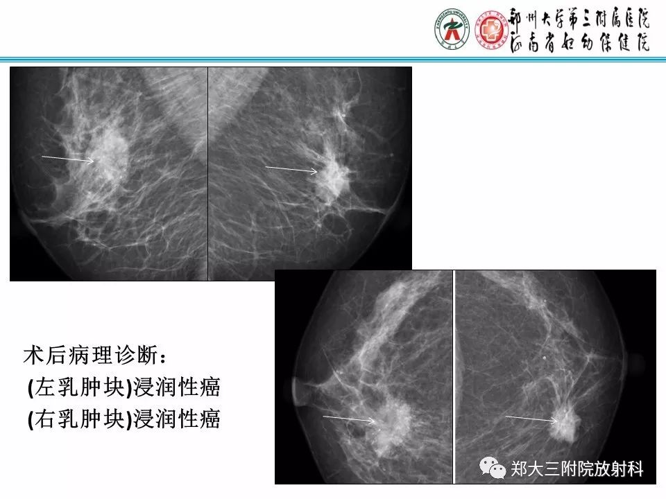 【PPT】乳腺X线病例分享