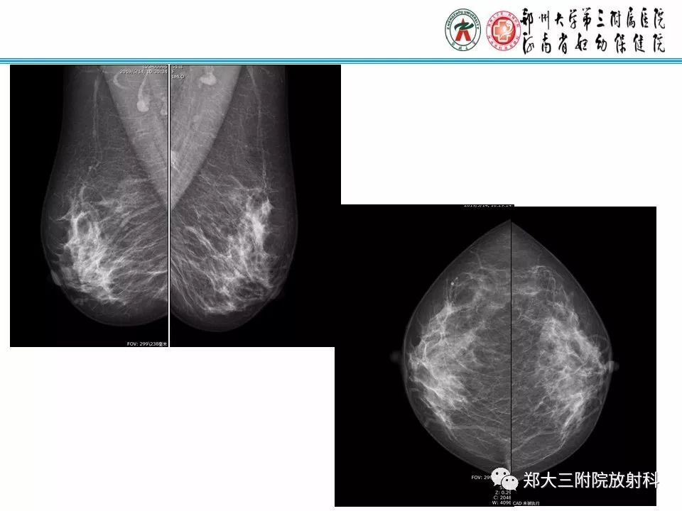 【PPT】乳腺X线病例分享