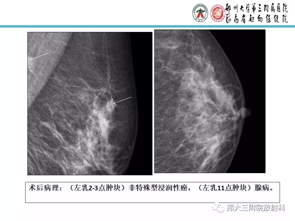【PPT】乳腺X线病例分享