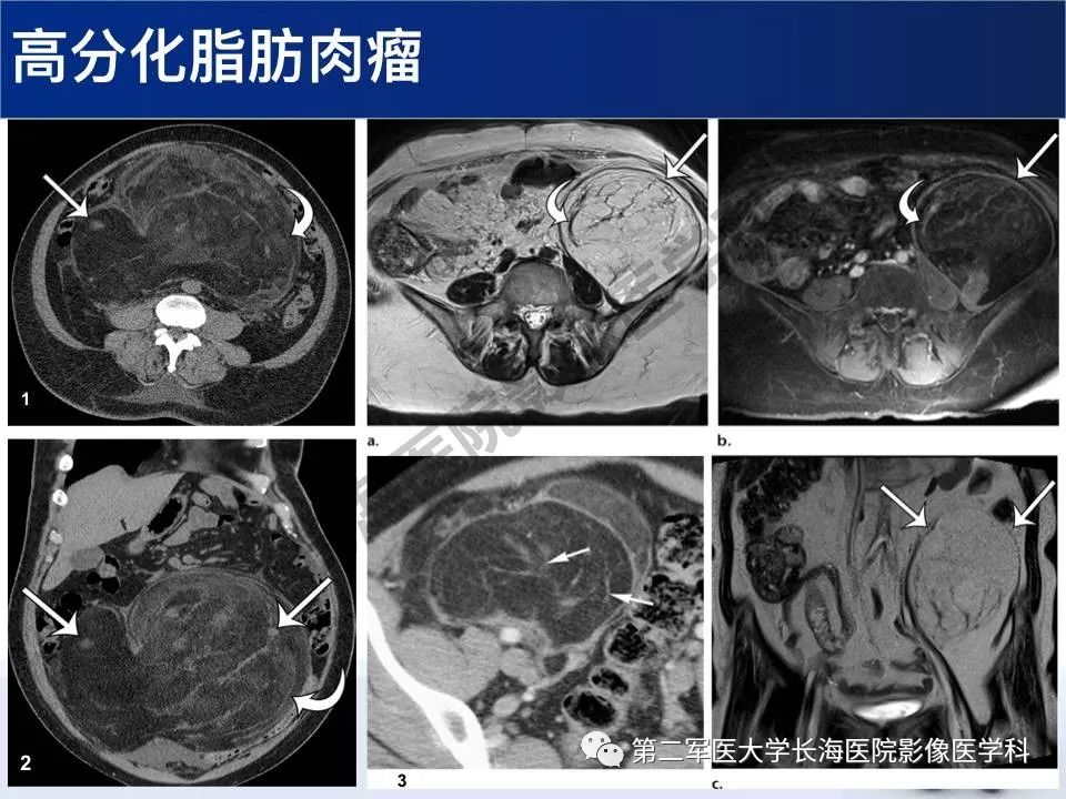 【PPT】原发性腹膜后含脂肪肿瘤影像学表现