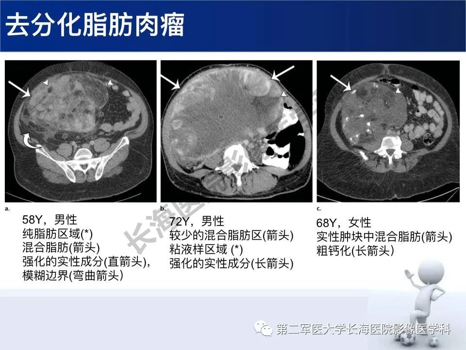 【PPT】原发性腹膜后含脂肪肿瘤影像学表现