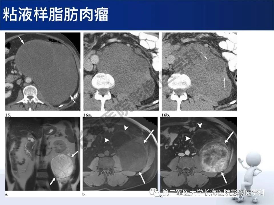 【PPT】原发性腹膜后含脂肪肿瘤影像学表现