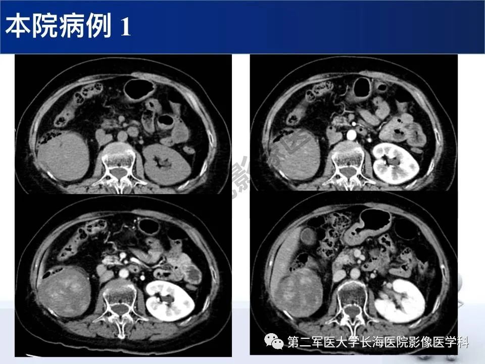 【PPT】原发性腹膜后含脂肪肿瘤影像学表现