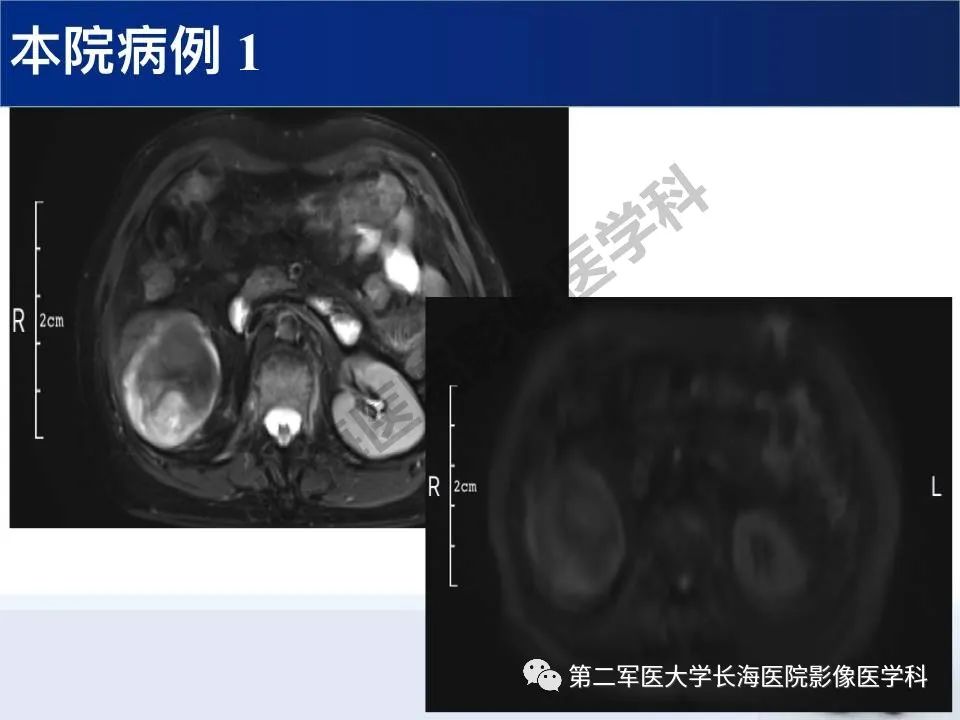 【PPT】原发性腹膜后含脂肪肿瘤影像学表现
