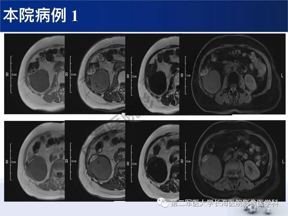 【PPT】原发性腹膜后含脂肪肿瘤影像学表现