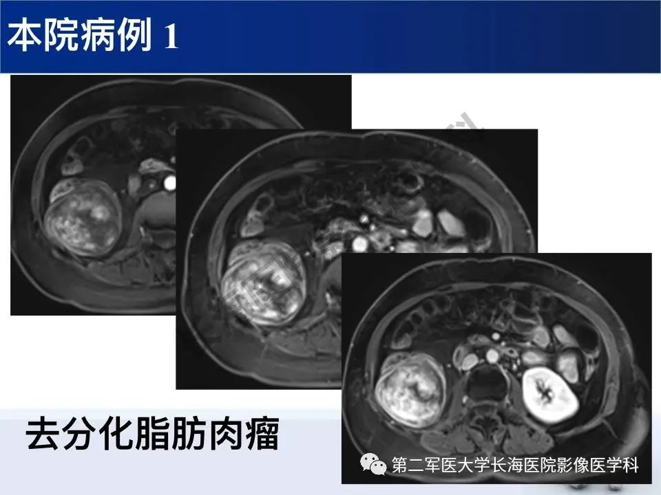 【PPT】原发性腹膜后含脂肪肿瘤影像学表现