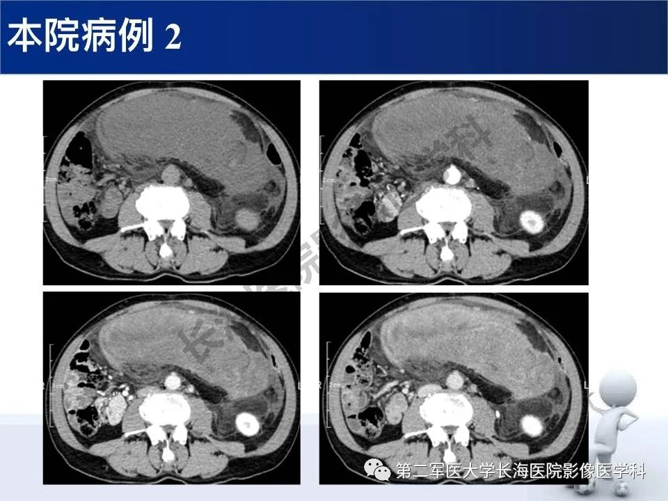 【PPT】原发性腹膜后含脂肪肿瘤影像学表现