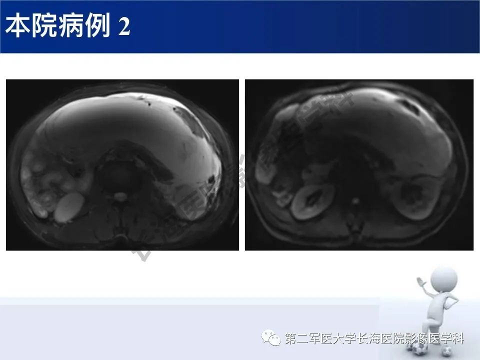 【PPT】原发性腹膜后含脂肪肿瘤影像学表现