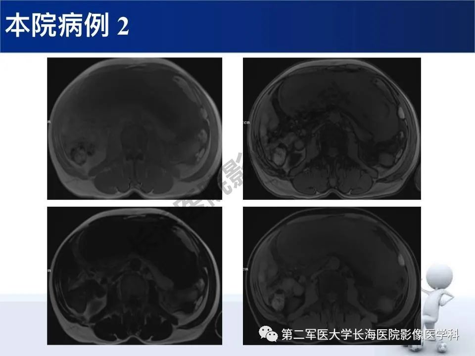 【PPT】原发性腹膜后含脂肪肿瘤影像学表现