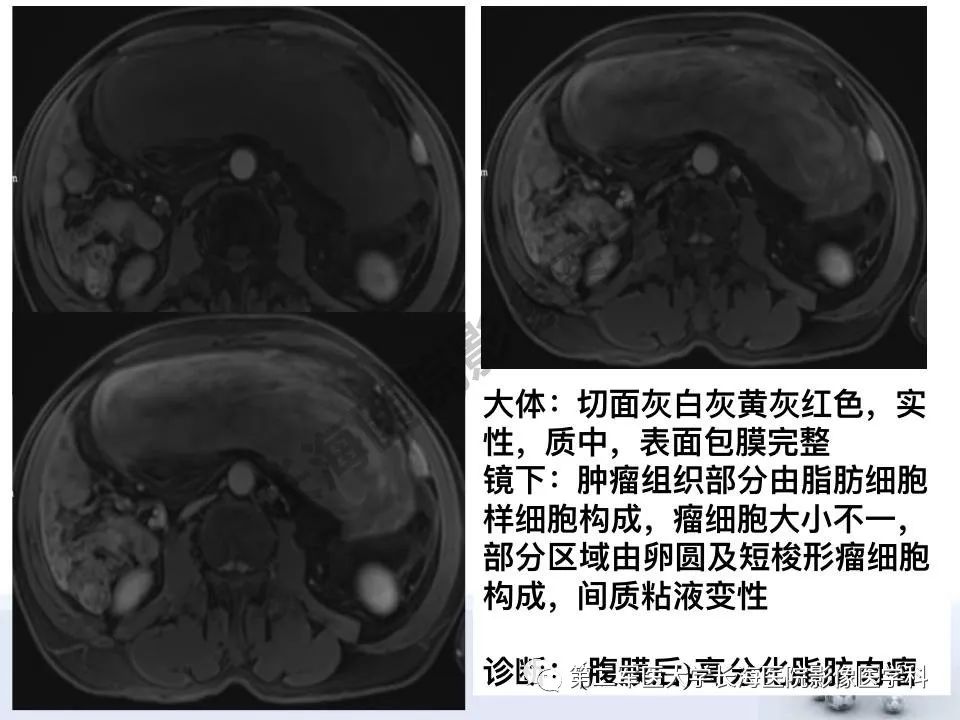 【PPT】原发性腹膜后含脂肪肿瘤影像学表现