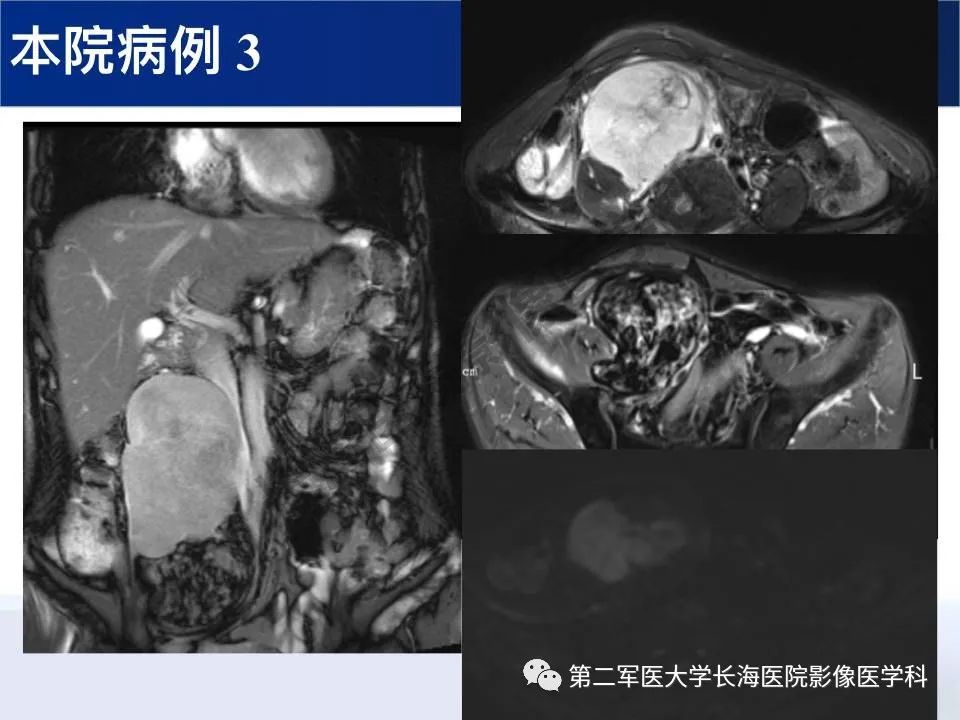 【PPT】原发性腹膜后含脂肪肿瘤影像学表现