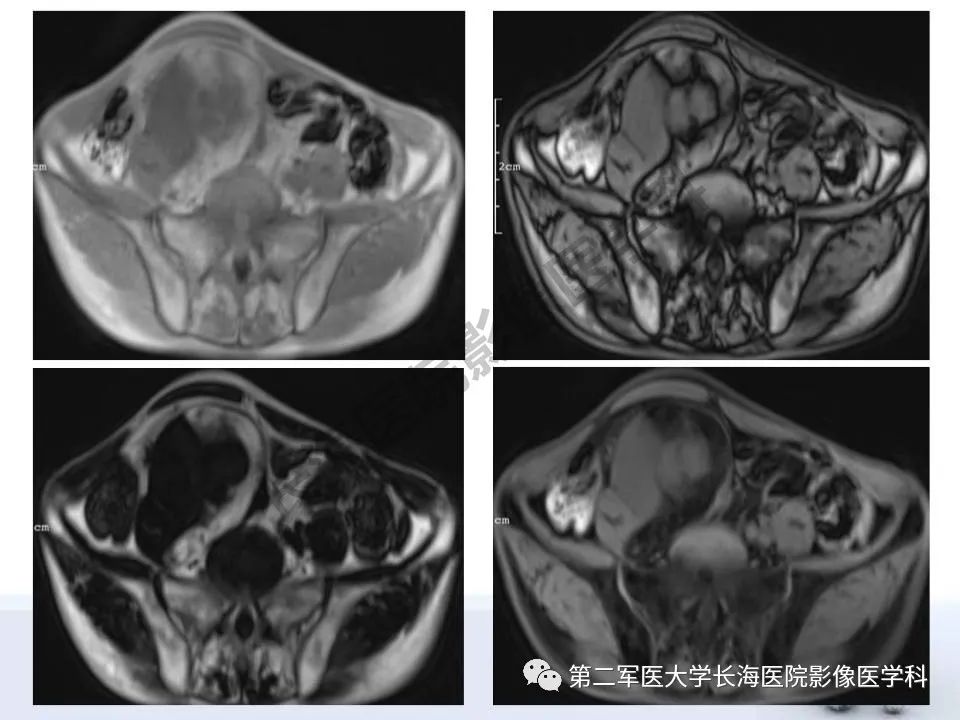 【PPT】原发性腹膜后含脂肪肿瘤影像学表现