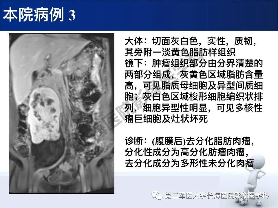 【PPT】原发性腹膜后含脂肪肿瘤影像学表现