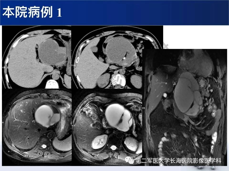 【PPT】原发性腹膜后含脂肪肿瘤影像学表现