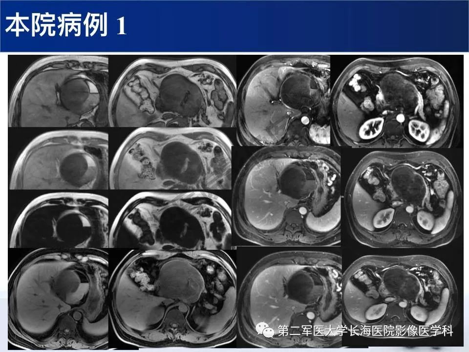 【PPT】原发性腹膜后含脂肪肿瘤影像学表现