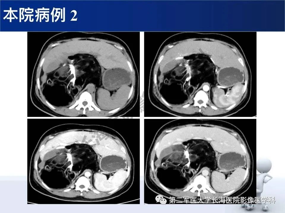 【PPT】原发性腹膜后含脂肪肿瘤影像学表现
