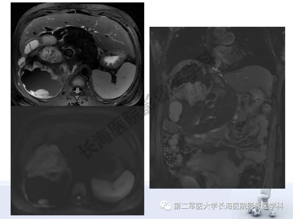 【PPT】原发性腹膜后含脂肪肿瘤影像学表现