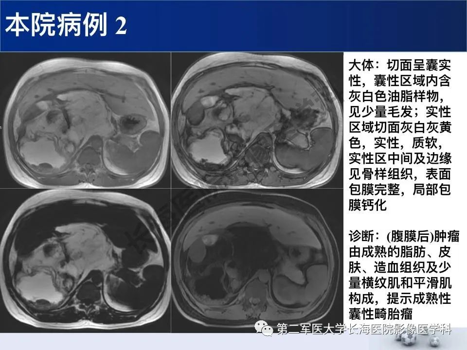 【PPT】原发性腹膜后含脂肪肿瘤影像学表现