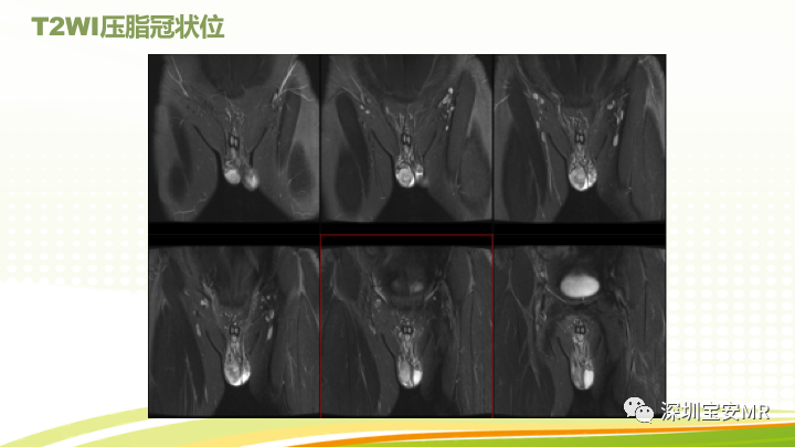 【PPT】影像病例学习：睾丸病变2例